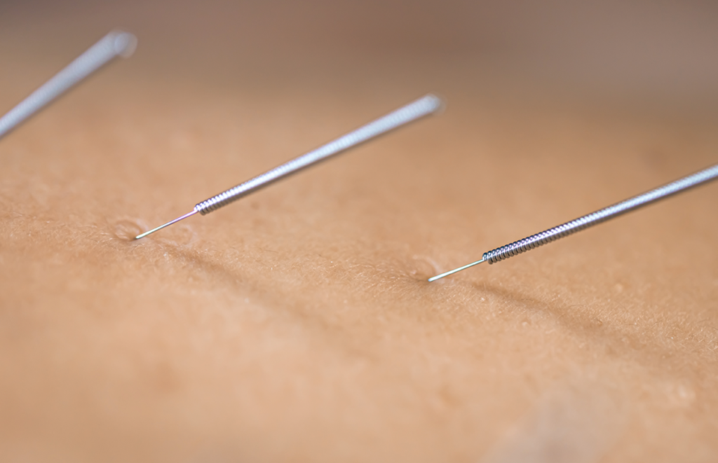 o-papel-do-shiatsu-e-da-acupuntura-na-reducao-do-estresse-e-ansiedade