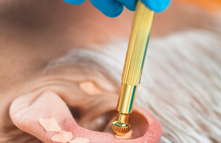 Esferas Magnéticas na Auriculoterapia: Benefícios e Aplicações
